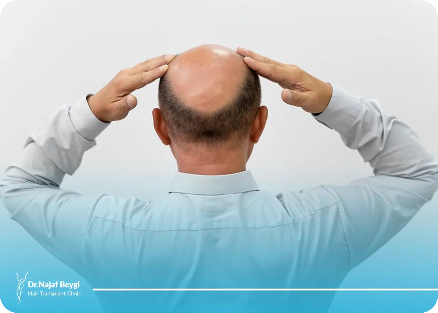 جدیدترین تکنیک برای کاشت مو در ناحیه ورتکس