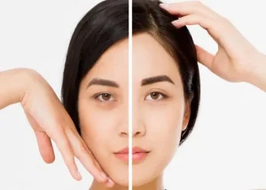 چه مدت بعد از لیفت ابرو می‌توان به فعالیت‌ های روزمره بازگشت؟