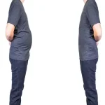 چرا بعد از لیپوماتیک شکم خطوط ناصافی زیر پوست دیده می‌شود؟