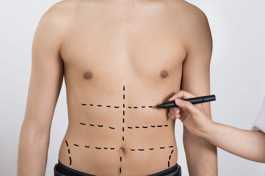دستگاه لیپوست چیست و تفاوت آن با لیپوماتیک؟