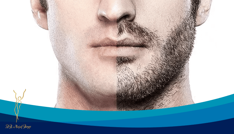 همه چیز درباره کاشت ریش و سبیل
