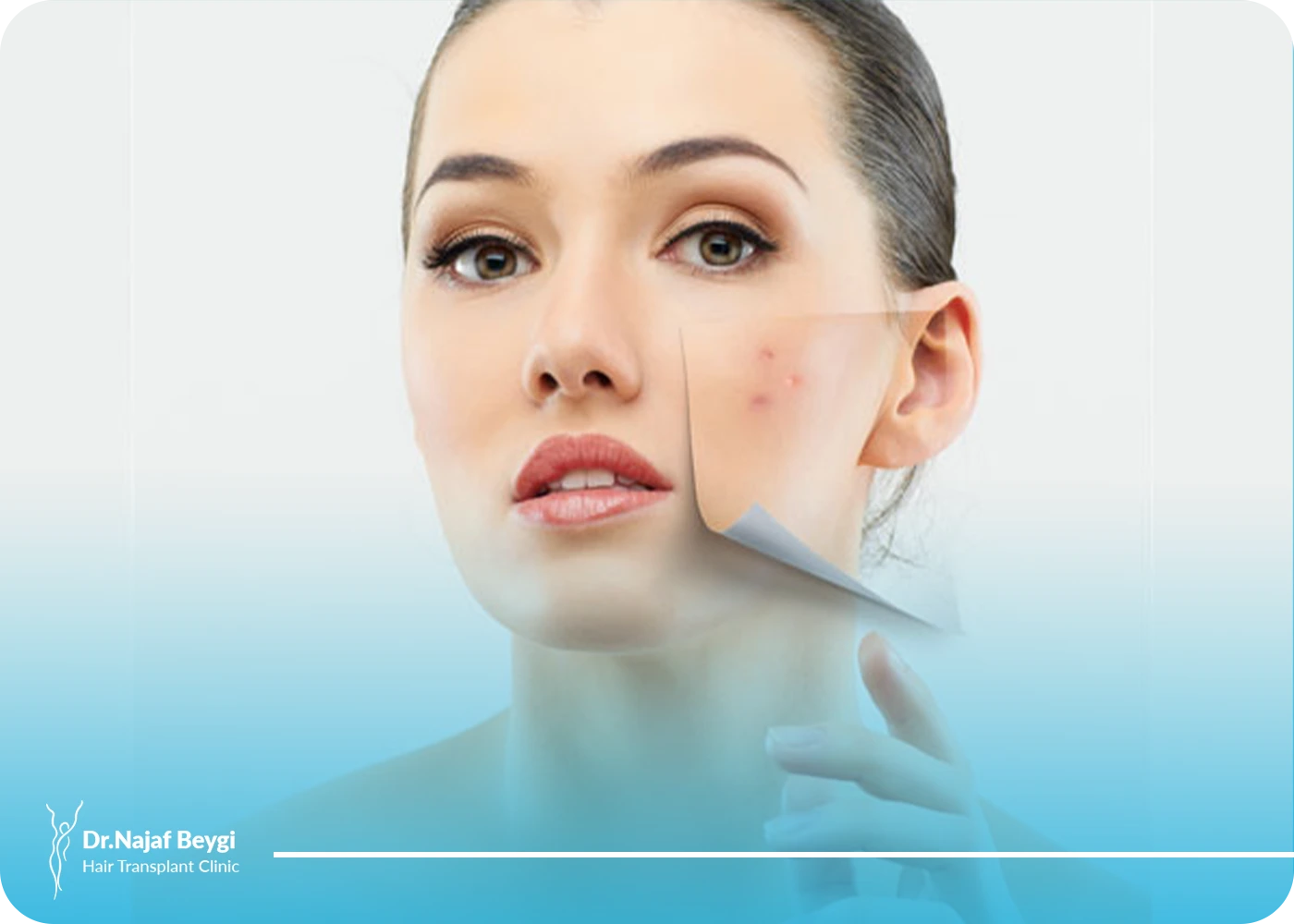علت ایجاد جوش صورت بعد از عمل بینی و راههای درمان آن